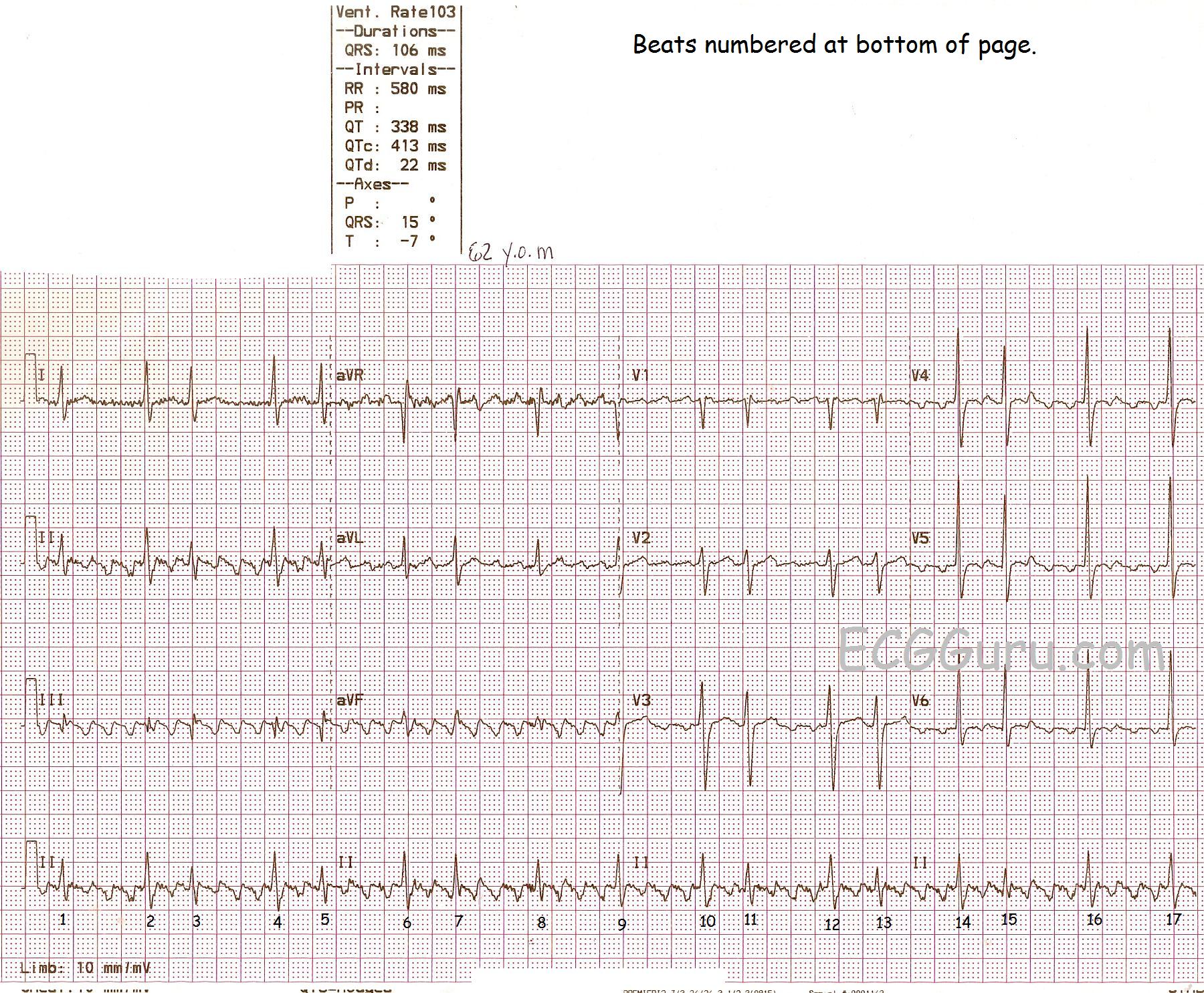 Atrial Flutter With Variable Conduction Ecg Guru Instructor Resources